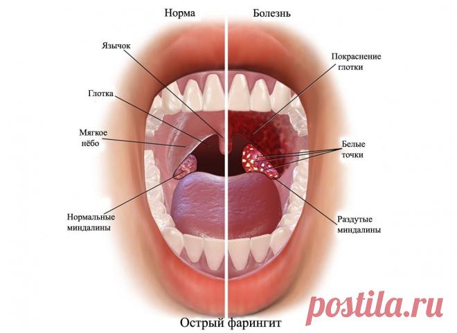 Симптомы и лечение фарингита. Лечим боль в горле