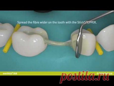 everStickC&amp;B fibre reinforced bridge for posterior region.wmv