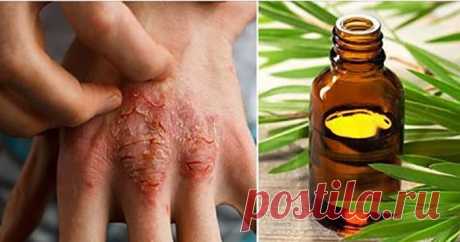 Эфирное масло, которое борется с акне, экземой и псориазом! - Женский Журнал Чайное дерево родом из Австралии. Масло, которое извлекается из него, собирается путем паровой дистилляции листьев и веточек. Это масло обладает многочисленными целебными соединениями и имеет много преимуществ для здоровья. Это 9 наиболее полезных применений: Экзема и псориаз Масло содержит множество противовоспалительных свойств, которые могут помочь вам в борьбе с псориазом и экземой, поэтому вам просто …