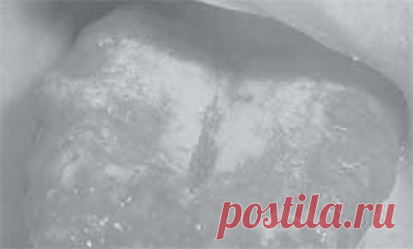 Кандидозы слизистых оболочек полости рта