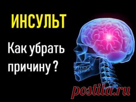 Инсульт. Причина инсульта, восстановление и лечение.