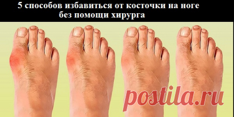 5 СПОСОБОВ ИЗБАВИТЬСЯ ОТ КОСТОЧКИ НА НОГЕ БЕЗ ПОМОЩИ ХИРУРГА