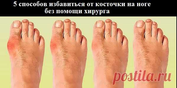 5 СПОСОБОВ ИЗБАВИТЬСЯ ОТ КОСТОЧКИ НА НОГЕ БЕЗ ПОМОЩИ ХИРУРГА