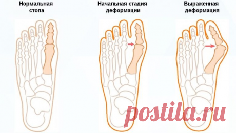 Симптомы подагры: современные методы и способы лечения Здравствуйте, дорогие читатели. Об этом заболевании, медики знали более 200 лет назад. Симптомы...