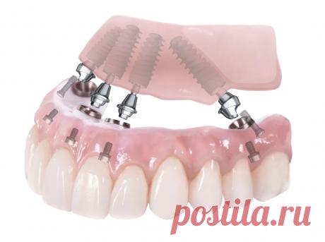 MitraLab - базальная имплантация от лидеров рынка