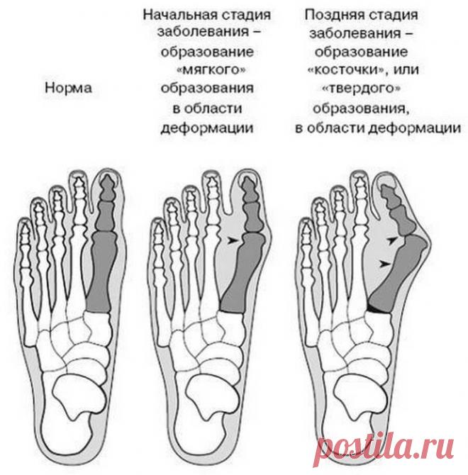 Эффективные упражнения от косточек на ногах