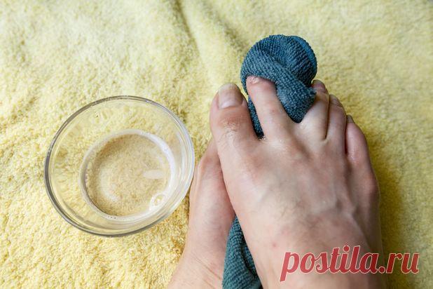 Лечение грибка ногтей уксусом в домашних условиях