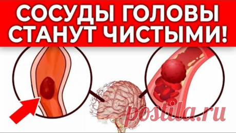 Пей ЭТО от головной боли! Сосуды головы станут ЧИСТЫМИ! | 3 способа очистить сосуды