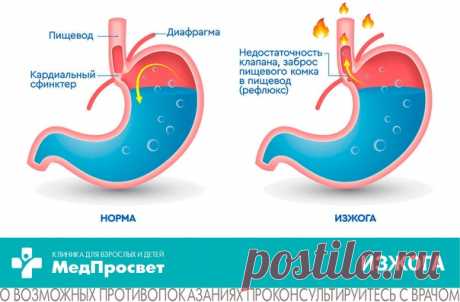 Беспокоит #изжога (жгучая боль за грудиной, кислый привкус во рту, ком в горле, отрыжка воздухом или пищей и др.)?

Изжога не заболевание, а симптом, поэтому для избавления от неприятных ощущений необходимо лечить основное заболевание.

Какие заболевания могут провоцировать изжогу?
Показать полностью...