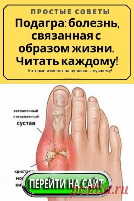 Подагра характеризуется высокой концентрацией мочевой кислоты в крови, которая затем накапливается в суставах, вызывая воспаление и боль. Бороться с проявлениями болезни помогают народные средства. Какие из них самые эффективные? Можно ли проводить лечение подагры в домашних условиях? Мы подготовили обзор лучших противоподагрических средств, рекомендуемых для борьбы с недугом.