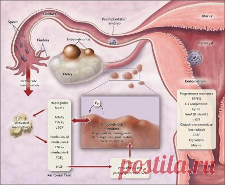 Причины возникновения, симптомы и лечение. Эндометриоз Эндометриоз — разрастание тканей, похожих на слизистую оболочку матки (эндометрий), в любом другом месте организма.