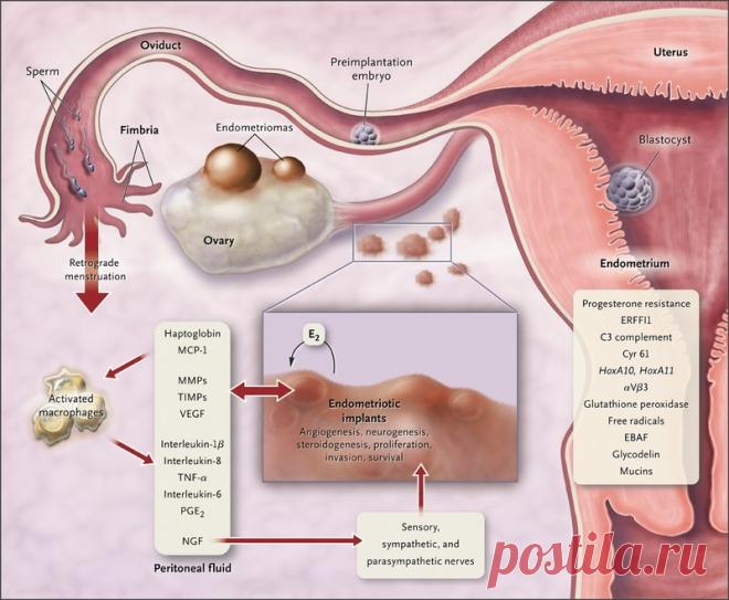 Причины возникновения, симптомы и лечение. Эндометриоз Эндометриоз — разрастание тканей, похожих на слизистую оболочку матки (эндометрий), в любом другом месте организма.