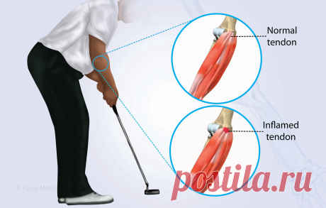 Because golfers are particularly prone to the ailment because of the nature of their activity, many people who participate in repetitive gripping or wrist flexion exercises suffer from golfer's elbow, also known as medial epicondylitis. Golfer's elbow discomfort must be managed and reduced using a multimodal approach since the pain and inflammation felt on the inside of the elbow can greatly interfere with day-to-day activities. This thorough guide examines the several methods of pain management