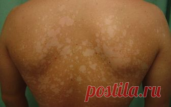 კანის დაავადების დერმატოლოგია. კანის დაავადებების სახეები ფოტოებით და სახელებით