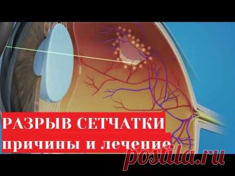 Разрыв сетчатки глаза - причины и лечение (лазерная коагуляция)