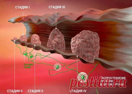 7 альтернатив колоноскопии для обнаружения рака прямой кишки | Рецепты здоровья мира | Дзен