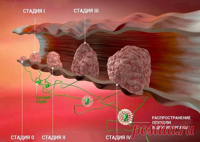 7 альтернатив колоноскопии для обнаружения рака прямой кишки | Рецепты здоровья мира | Дзен