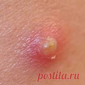 Чем лечить нарыв?