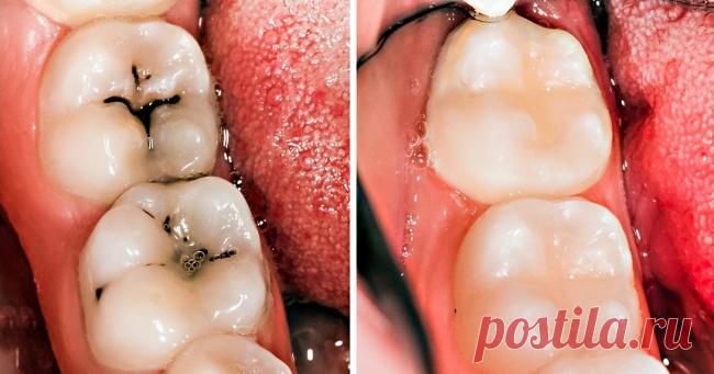 8 простых способов избавиться от кариеса и дыр в зубах естественным путем . Милая Я