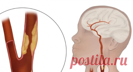 Как вернуть сосудам эластичность без лекарств Существует хороший метод почистить сосуды, вернуть им природную эластичность без таблеток.И в этом поможет на первый взгляд неприметное растение, которое мы видим каждый день, — пастушья сумка (в наро...