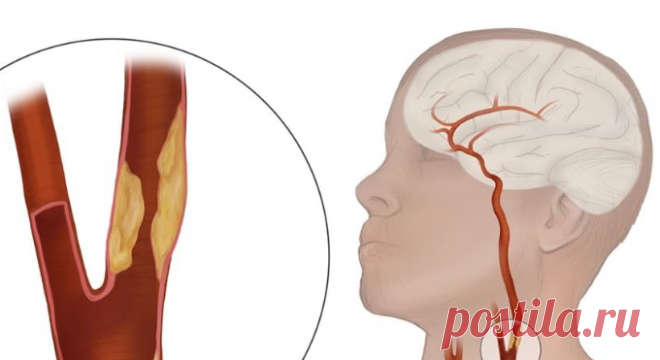 Как вернуть сосудам эластичность без лекарств Существует хороший метод почистить сосуды, вернуть им природную эластичность без таблеток.И в этом поможет на первый взгляд неприметное растение, которое мы видим каждый день, — пастушья сумка (в наро...