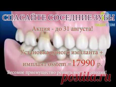 Отзывы о зубных имплантах osstem, рейтинг качественных имплантов с мировым именем