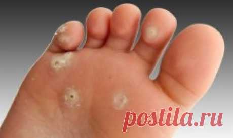 СТЕРЖНЕВОЙ МОЗОЛЬ ЛЕЧЕНИЕ В ДОМАШНИХ УСЛОВИЯХ — Копилочка полезных советов