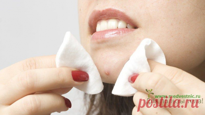 Как избавиться от прыщей и черных точек - 26 Марта 2015 - Для пользы тела!