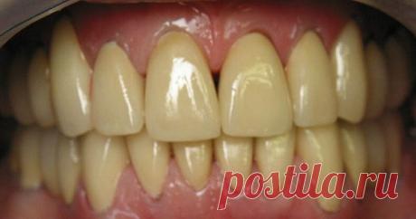 Фольга для отбеливания зубов