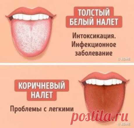 12 проблем, о которых может рассказать цвет языка!
