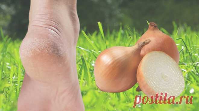 Простой рецепт от трескающихся пяток "намазал-смыл", после которого ноги как у девочки