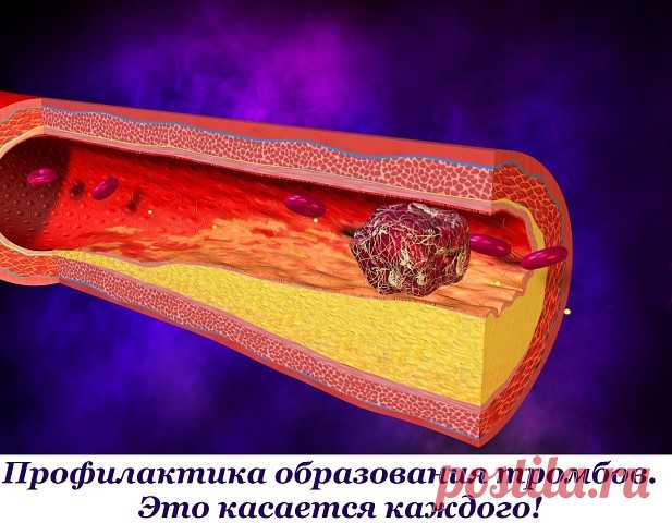Профилактика образования тромбов