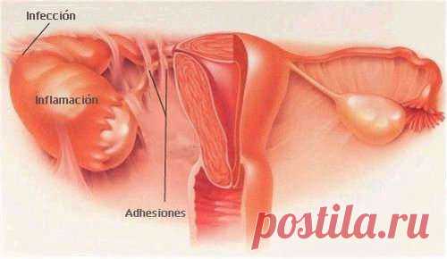 Síntomas de la enfermedad inflamatoria pélvica en la mujer (EIP) - Mejor Con Salud