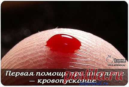 Кровопускание при инсульте-за и против