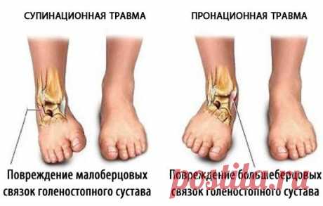 НЕСТАБИЛЬНОСТЬ ГОЛЕНОСТОПНОГО СУСТАВА: МАССАЖ



Голеностопный сустав выдерживает огромную нагрузку при стоянии и ходьбе, это один из самых «работающих» элементов опорно-двигательной системы. Своеобразная форма голеностопного сустава (он относится к блоковидным) обеспечивает небольшой объем движений — сгибание и разгибание с амплитудой до 65°(кроме того, при согнутой стопе возможны незначительные круговые движения) и большую устойчивость. 

Прочные и эластичные связки укре...