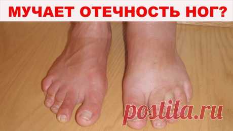 Отеки и 5 способов вывести лишнюю воду из организма без лекарств.

Организм способен задерживать воду по массе причин. Одни незначительные, такие как употребление соли или выпитый накануне алкоголь. А иногда на это у него серьёзные основания, выраженные в хронических болезнях печени, почек и сердца.

Как вывести лишнюю воду не прибегая к серьезным медикаментозным практикам расскажет статья.