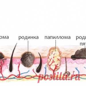 Бородавки, родинки и папилломы: чем они отличаются? Почему они появляются...