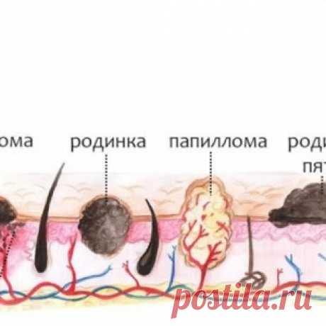 Бородавки, родинки и папилломы: чем они отличаются? Почему они появляются...