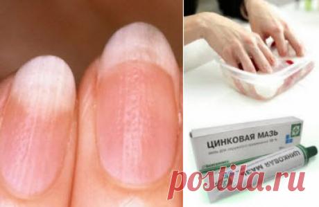 ҚАЛДЫҚТАРДЫҢ ПОРИЦИЕНТТІҢ ЕРЕЖЕЛЕРДІҢ ЕРЕКШЕЛІКТЕРІ
Псориаз - организмнің иммундық жүйесінің қалыпты жұмыс істеуі бұзылған (аутоиммунды шығу) кезде дамитын инфекциялық емес табиғаттың созылмалы тері ауруы. Псориаз белгілері әрдайым теріге сыртқы көрініс бермейді және толқынды немесе нүктелік деформация және тырнақтардың ашықтығы түрінде көрінеді. Ногтей псориазы көбінесе түсініксіз генездің патологиясы болғандықтан, иммунитетті күшейтуге арналған емдеу мен кешенді тек науқ...