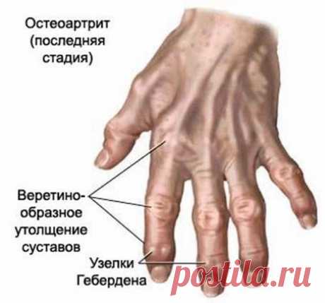 ХИЖИНА ЗДОРОВЬЯ. Артрит рук. Узлы Гебердена