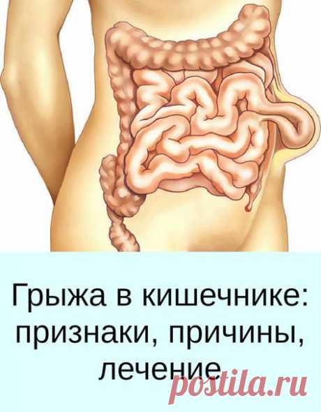 Натуральная формула Traufreel направлена на постепенное уменьшение грыжи и избавление от болезненных симптомов при грыже. Благодаря нормализации внутрибрюшного давления, а также налаживанию кровообращения и тонуса стенок в брюшной и паховой области, боли при грыже быстро проходят, риск ущемления сводится к нулю, а сама грыжа устраняется