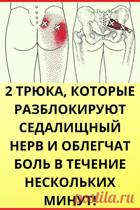 2 трюка, которые разблокируют седалищный нерв и облегчат боль в течение нескольких минут!