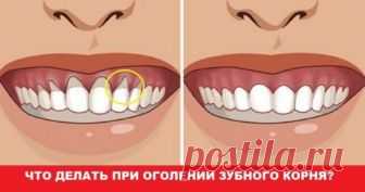 Оголилась шейка зуба? Узнай, как вернуть десну обратно! — Копилочка полезных советов