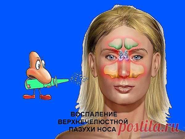 Вылечить гайморит: симптомы заболевания, методы лечения |