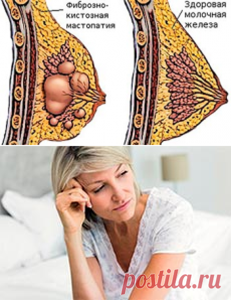 Фиброкистозная мастопатия: причины появления, методы лечения