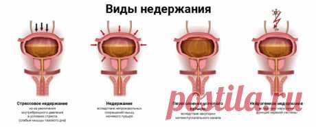 Лечение недержания мочи травами.