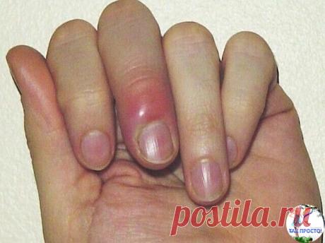 Хочу поделиться рецептам от панариция.

Сама я медик, работала в  детской консультации, потом в физиотерапии. Однажды, помогая делать  прививки в детсаду, услышала от пожилой медсестры: "Запомни рецепт от  панариция, я чуть ногу не потеряла, а он меня на ноги поставил за 2 дня.  Ступню раздуло, палец почернел, ни спать, ни есть не могла". Вроде оно  тогда мне и ни к чему было, но запомнила.   30 минут держать конечность в растворе марганцовки бледно-розового  цвета.  30 ми...