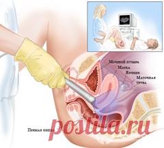 Трансвагинальное узи – показания, подготовка, проведение, противопоказания