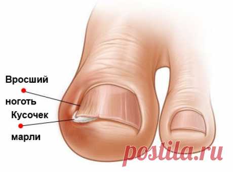 ПРОБЛЕМА ВРОСШЕГО НОГТЯ