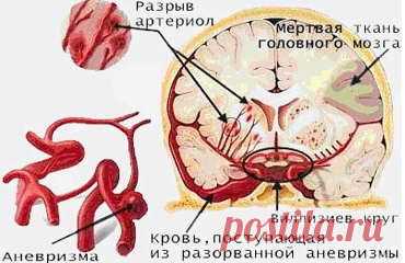 Еще одно напоминание. ИНСУЛЬТ - ЗАПОМНИТЕ ВСЕГО ТРИ ПЕРВЫХ ШАГА
